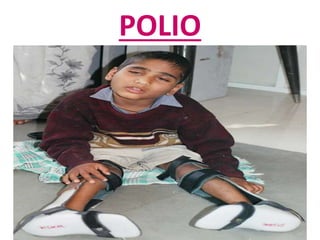 POLIO
 