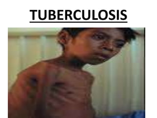 TUBERCULOSIS
 