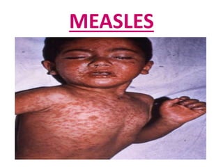 MEASLES
 