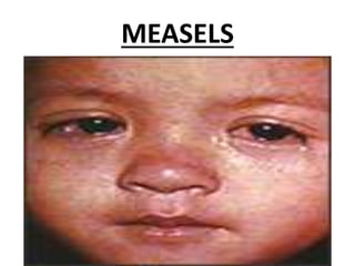MEASELS
 