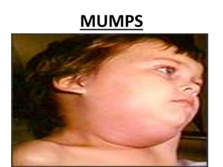 MUMPS
 
