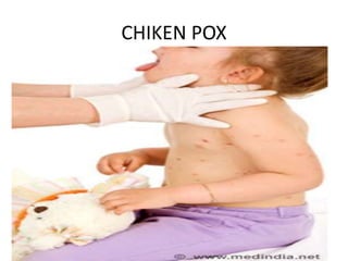 CHIKEN POX
 