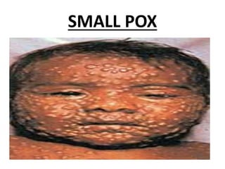 SMALL POX
 