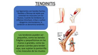 TENDINITIS
Los ligamentos son bandas fuertes,
flexibles y fibrosas de tejido que
conectan los músculos con los
huesos. Cuando los tendones se
inflaman (hinchan), irritan o sufren
desgarros microscópicos, la
condición se denomina tendinitis.
Los tendones pueden ser
pequeños, como las bandas
frágiles y pequeñísimas en las
manos o grandes, como las
gruesas cuerdas para tender
ropa, que sujetan la pantorrilla
o los músculos de los muslos.
 