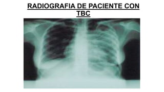 RADIOGRAFIA DE PACIENTE CON
TBC
 