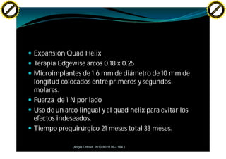 F T ra n sf o                                                                                        F T ra n sf o
          PD                   rm                                                                              PD                   rm
      Y                                                                                                    Y
 Y




                                                                                                      Y
                                er




                                                                                                                                     er
ABB




                                                                                                     ABB
                          y




                                                                                                                               y
                       bu




                                                                                                                            bu
                                    2.0




                                                                                                                                         2.0
                     to




                                                                                                                          to
                  re




                                                                                                                       re
                he




                                                                                                                     he
           k




                                                                                                                k
          lic




                                                                                                               lic
      C




                                                                                                           C
      w                        om                                                                          w                        om
  w




                                                                                                       w
          w.                                                                                                   w.
               A B B Y Y.c                                                                                          A B B Y Y.c




                                          — Expansión Quad Helix
                                          — Terapia Edgewise arcos 0.18 x 0.25
                                          — Microimplantes de 1.6 mm de diámetro de 10 mm de
                                            longitud colocados entre primeros y segundos
                                            molares.
                                          — Fuerza de 1 N por lado
                                          — Uso de un arco lingual y el quad helix para evitar los
                                            efectos indeseados.
                                          — Tiempo prequirúrgico 21 meses total 33 meses.

                                                         (Angle Orthod. 2010;80:1176–1184.)
 