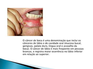 O câncer de boca é uma denominação que inclui os cânceres de lábio e de cavidade oral (mucosa bucal, gengivas, palato duro, língua oral e assoalho da boca). O câncer de lábio é mais freqüente em pessoas brancas, e registra maior ocorrência no lábio inferior em relação ao superior. 
