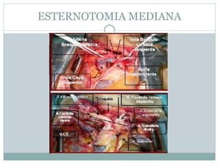 ESTERNOTOMIA MEDIANA