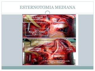 ESTERNOTOMIA MEDIANA