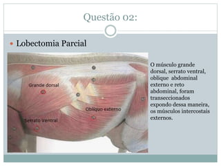 Questão 02:
Lobectomia Parcial
O músculo grande
dorsal, serrato ventral,
oblique abdominal
externo e reto
abdominal, foram
transeccionados
expondo dessa maneira,
os músculos intercostais
externos.