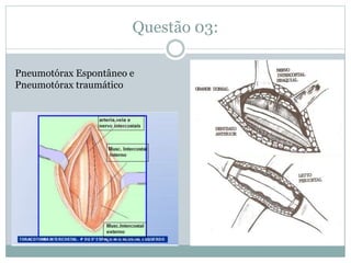 Questão 03:
Pneumotórax Espontâneo e
Pneumotórax traumático
