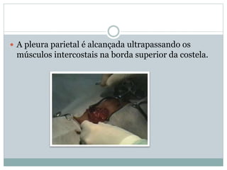  A pleura parietal é alcançada ultrapassando os
músculos intercostais na borda superior da costela.