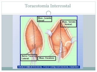 Toracotomia Intercostal