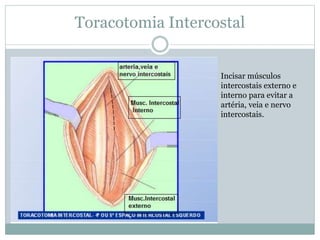 Toracotomia Intercostal
Incisar músculos
intercostais externo e
interno para evitar a
artéria, veia e nervo
intercostais.