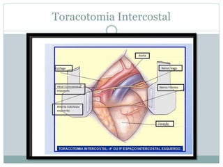 Toracotomia Intercostal