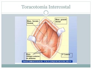 Toracotomia Intercostal