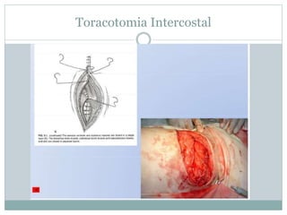 Toracotomia Intercostal