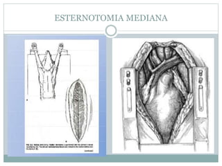ESTERNOTOMIA MEDIANA