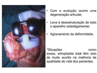 • Com a evolução ocorre uma
degeneração articular.
• Leva à desestruturação de todo
o aparelho osteoligamentar.
• Agravamento da deformidade.

*Situações
como
essas, artroplastia total têm sido
de muito auxílio na melhoria da
qualidade de vida dos pacientes.

 