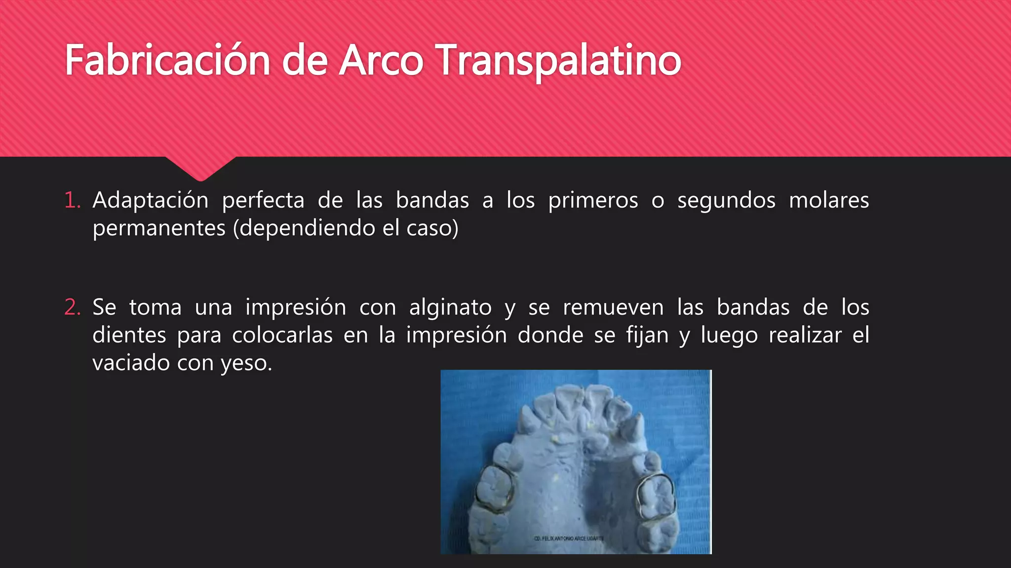 Arco Transpalatino, Bihelix, Ansa Distal | PPTX