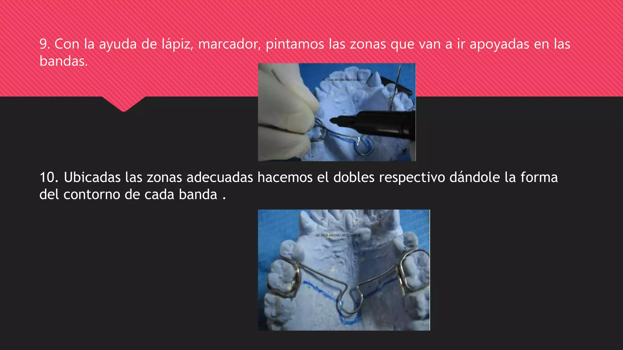 Arco Transpalatino, Bihelix, Ansa Distal | PPTX