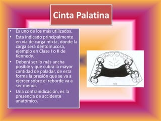 Cinta PalatinaEs uno de los más utilizados.Esta indicado principalmente en vía de carga mixta, donde la carga será dentomucosa, ejemplo en Clase I o II de Kennedy.Deberá ser lo más ancha posible y que cubra la mayor cantidad de paladar, de esta forma la presión que se va a ejercer sobre el reborde va a ser menor.Una contraindicación, es la presencia de accidente anatómico.