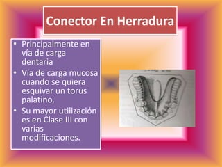 Conector En HerraduraPrincipalmente en vía de carga dentaria Vía de carga mucosa cuando se quiera esquivar un torus  palatino.Su mayor utilización es en Clase III con varias modificaciones.