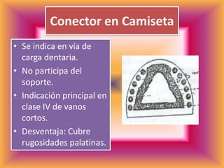 Conector en CamisetaSe indica en vía de carga dentaria. No participa del soporte.Indicación principal en clase IV de vanos cortos.Desventaja: Cubre rugosidades palatinas.