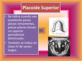 Placoide SuperiorSe indica cuando van quedando pocas piezas remanentes, piezas pilares tienen un soporte periodontal disminuido.También se indica en clase IV de vanos largos.