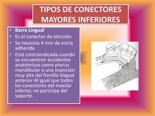 TIPOS DE CONECTORES MAYORES INFERIORESBarra LingualEs el conector de elección Se necesita 4 mm de encía adheridaEstá contraindicada cuando se encuentren accidentes anatómicos como ptorus mandibular o una inserción muy alta del frenillo lingual anterior Al igual que todos los conectores del maxilar inferior, no participa del soporte. 
