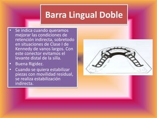 Barra Lingual DobleSe indica cuando queramos mejorar las condiciones de retención indirecta, sobretodo en situaciones de Clase I de Kennedy de vanos largos. Con este conector evitamos el levante distal de la silla.Buena Rigidez.Cuando se quiera estabilizar piezas con movilidad residual, se realiza estabilización indirecta. 