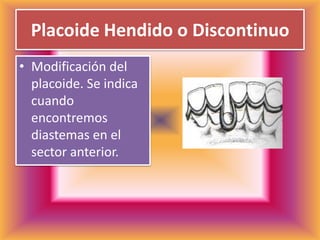 Placoide Hendido o DiscontinuoModificación del placoide. Se indica cuando encontremos diastemas en el sector anterior.