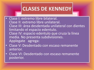 CLASES DE KENNEDYClase I: extremo libre bilateral.Clase II: extremo libre unilateral.Clase III: área desdentada unilateral con dientes limitando el espacio edentulo.Clase IV: espacio edentulo que cruza la línea media. No presenta subdivisiones.Applegate   agrega:Clase V: Desdentado con escaso remanente anterior.Clase VI:Desdentado con escaso remanente posterior.