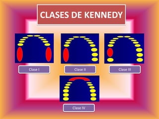 CLASES DE KENNEDYClase IClase IIIClase IIClase IV