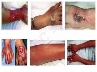 Unknown facts about iv cannulation