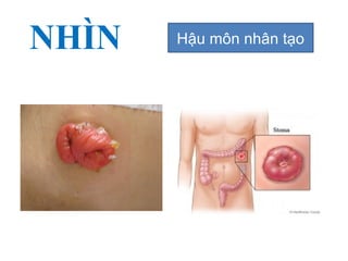 NHÌN Hậu môn nhân tạo
 