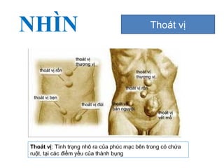 NHÌN Thoát vị
Thoát vị: Tình trạng nhô ra của phúc mạc bên trong có chứa
ruột, tại các điểm yếu của thành bụng
 