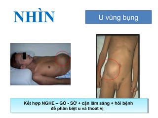 NHÌN U vùng bụng
Kết hợp NGHE – GÕ - SỜ + cận lâm sàng + hỏi bệnh
để phân biệt u và thoát vị
Kết hợp NGHE – GÕ - SỜ + cận lâm sàng + hỏi bệnh
để phân biệt u và thoát vị
 
