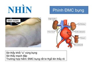 NHÌN Phình ĐMC bụng
Sờ thấy khối “u” vùng bụng
Sờ thấy mạch đập
Trường hợp hiếm: ĐMC bụng rất togồ lên thấy rõ
 
