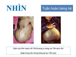 NHÌN Tuần hoàn bàng hệ
Giãn các tĩnh mạch nối TM thượng vị nông với TM cạnh rốn
(Gặp trong hội chứng tăng áp lực TM cửa)
 
