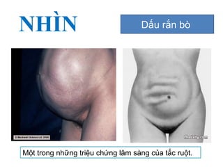 NHÌN Dấu rắn bò
Một trong những triệu chứng lâm sàng của tắc ruột.
 