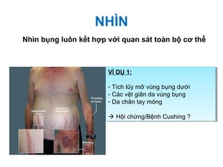NHÌN
Nhìn bụng luôn kết hợp với quan sát toàn bộ cơ thể
VÍ DỤ 1:
- Tích lũy mỡ vùng bụng dưới
- Các vệt giãn da vùng bụng
- Da chân tay mỏng
 Hội chứng/Bệnh Cushing ?
VÍ DỤ 1:
- Tích lũy mỡ vùng bụng dưới
- Các vệt giãn da vùng bụng
- Da chân tay mỏng
 Hội chứng/Bệnh Cushing ?
 