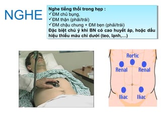 NGHE
Nghe tiếng thổi trong hẹp :
ĐM chủ bụng,
ĐM thận (phải/trái)
ĐM chậu chung + ĐM bẹn (phải/trái)
Đặc biệt chú ý khi BN có cao huyết áp, hoặc dấu
hiệu thiếu máu chi dưới (teo, lạnh,…)
Nghe tiếng thổi trong hẹp :
ĐM chủ bụng,
ĐM thận (phải/trái)
ĐM chậu chung + ĐM bẹn (phải/trái)
Đặc biệt chú ý khi BN có cao huyết áp, hoặc dấu
hiệu thiếu máu chi dưới (teo, lạnh,…)
 