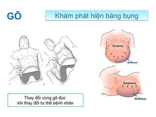 Khám phát hiện báng bụngKhám phát hiện báng bụng
Thay đổi vùng gõ đục
khi thay đổi tư thế bệnh nhân
GÕ
 