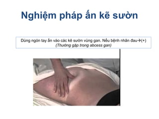 Nghiệm pháp ấn kẽ sườn
Dùng ngón tay ấn vào các kẽ sườn vùng gan. Nếu bệnh nhân đau(+)
(Thường gặp trong abcess gan)
 