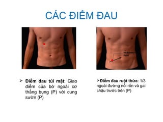 CÁC ĐIỂM ĐAU
 Điểm đau túi mật: Giao
điểm của bờ ngoài cơ
thẳng bụng (P) với cung
sườn (P)
Điểm đau ruột thừa: 1/3
ngoài đường nối rốn và gai
chậu trước trên (P)
 