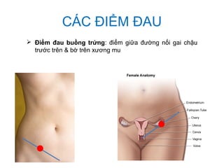 CÁC ĐIỂM ĐAU
 Điểm đau buồng trứng: điểm giữa đường nối gai chậu
trước trên & bờ trên xương mu
 