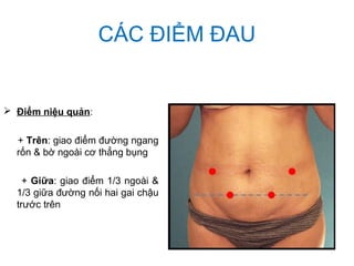 CÁC ĐIỂM ĐAU
 Điểm niệu quản:
+ Trên: giao điểm đường ngang
rốn & bờ ngoài cơ thẳng bụng
+ Giữa: giao điểm 1/3 ngoài &
1/3 giữa đường nối hai gai chậu
trước trên
 