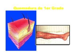 Quemadura de 1er Grado