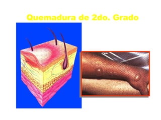 Quemadura de 2do. Grado